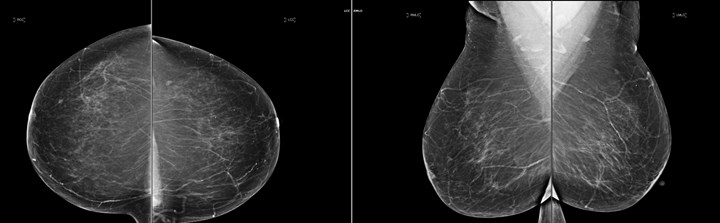 Images of segmental breast calcifications sorry, that Still images of segmental breast calcifications remarkable